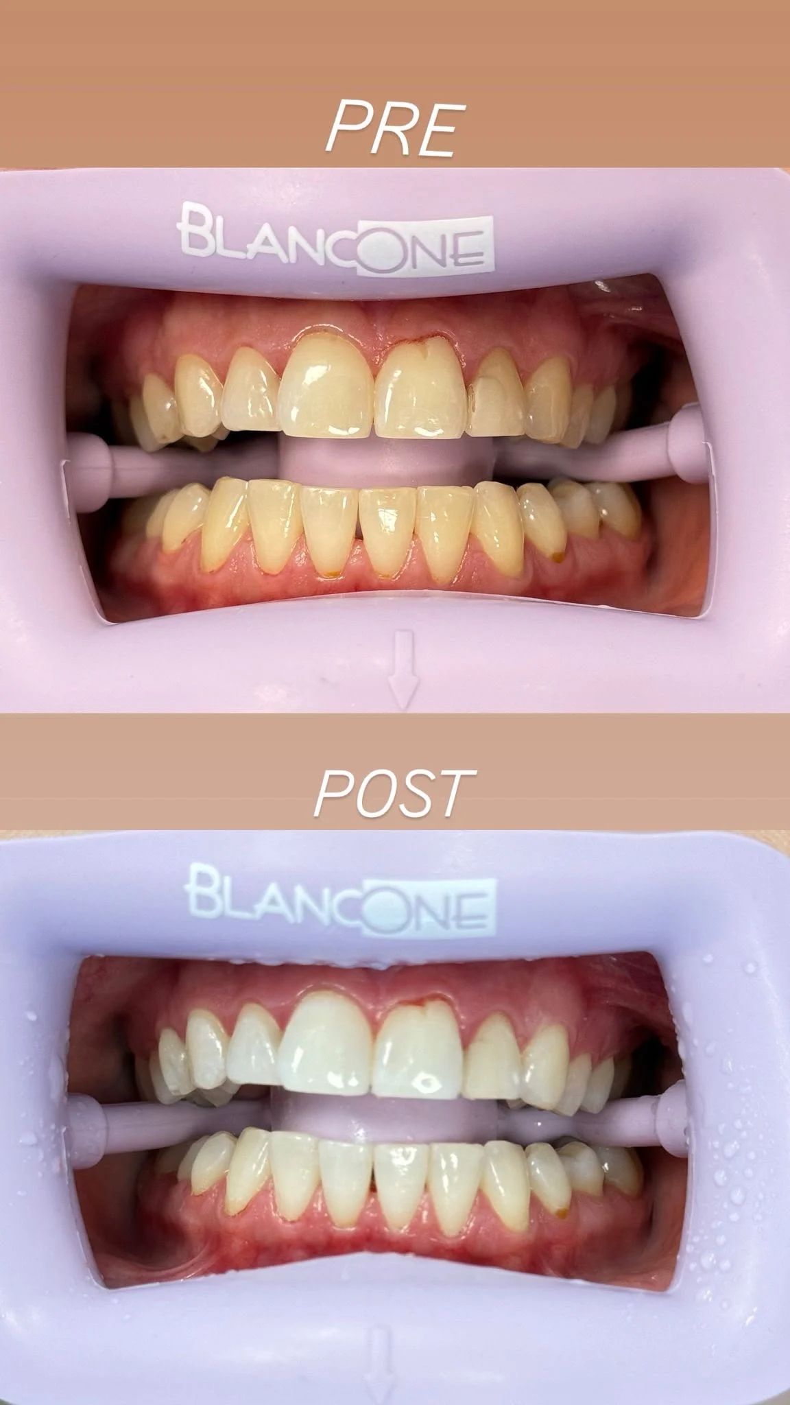 Documentazione fotografica originale di sbiancamento dentale: prima e dopo, immagine completa