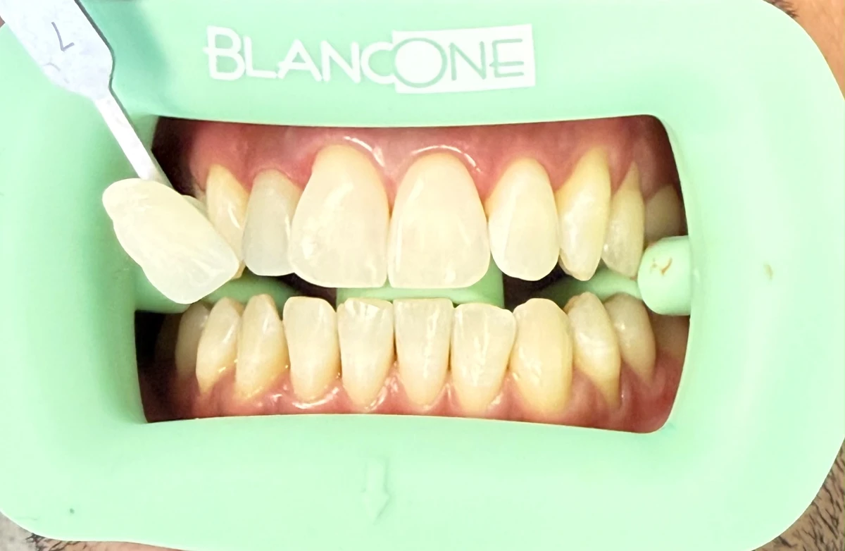 Fotografia dentale con retrattore verde e campione di colore accanto ai denti