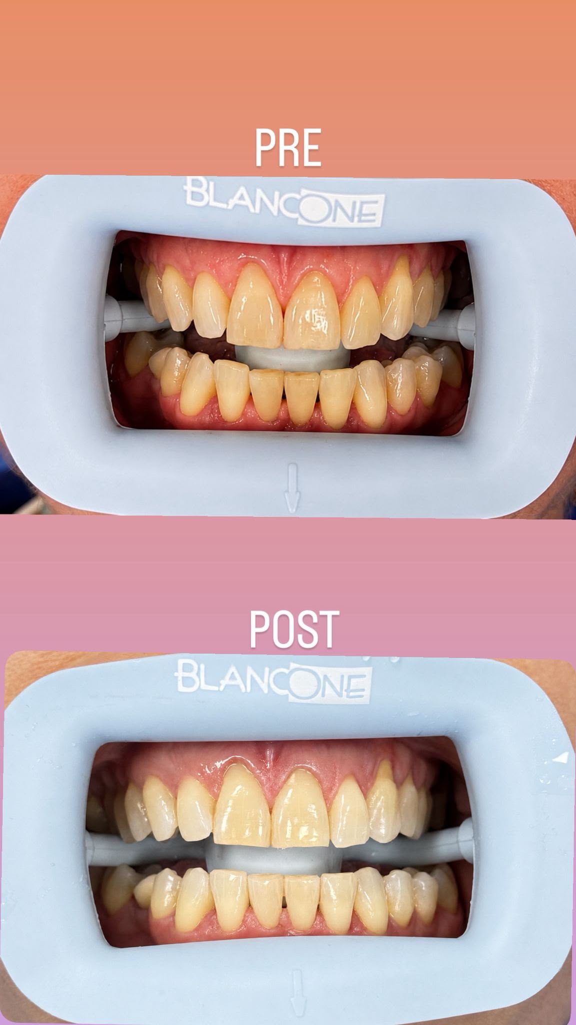 Documentazione fotografica originale di sbiancamento dentale: prima e dopo, immagine completa